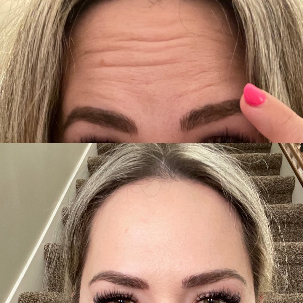 Know more about Xeomin wrinkle treatment in Farmington, UT