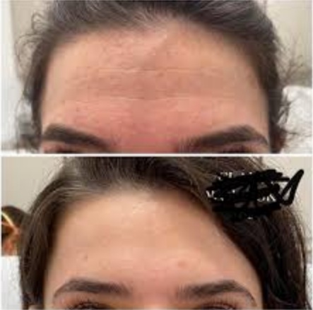 Know more about Xeomin treatments in Centerville, UT