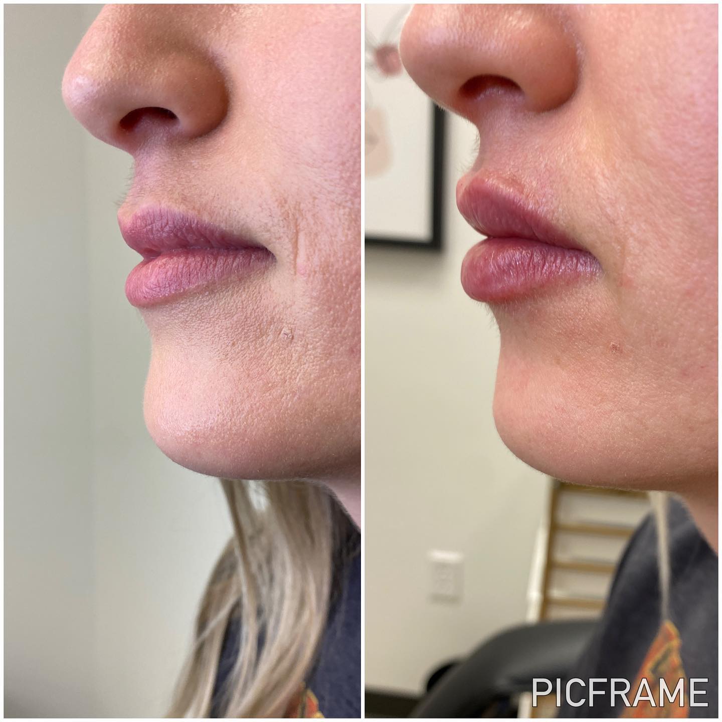 Take help of Revanesse Versa injection in Farmington, UT