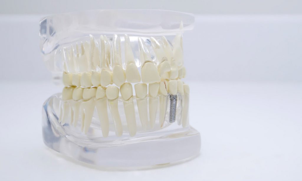 What to expect during dental implant treatment?