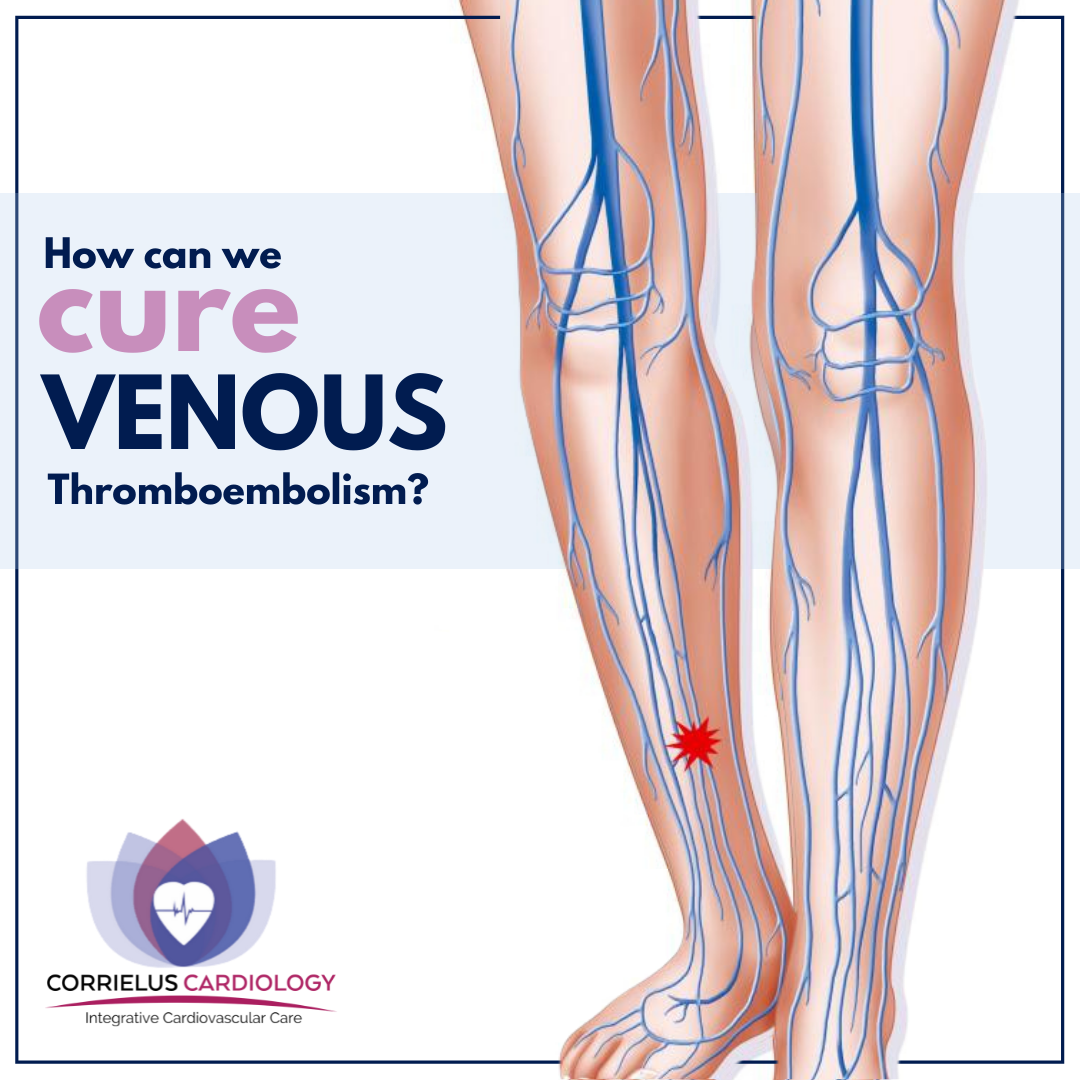 Varicose Veins Specialist in Philadelphia