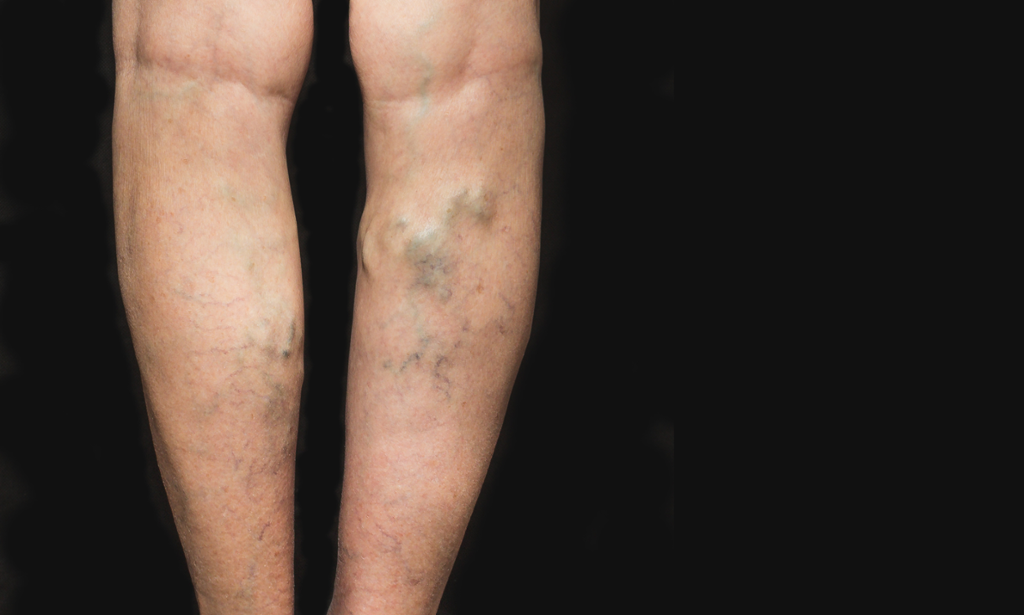 Varicose Veins Treatment