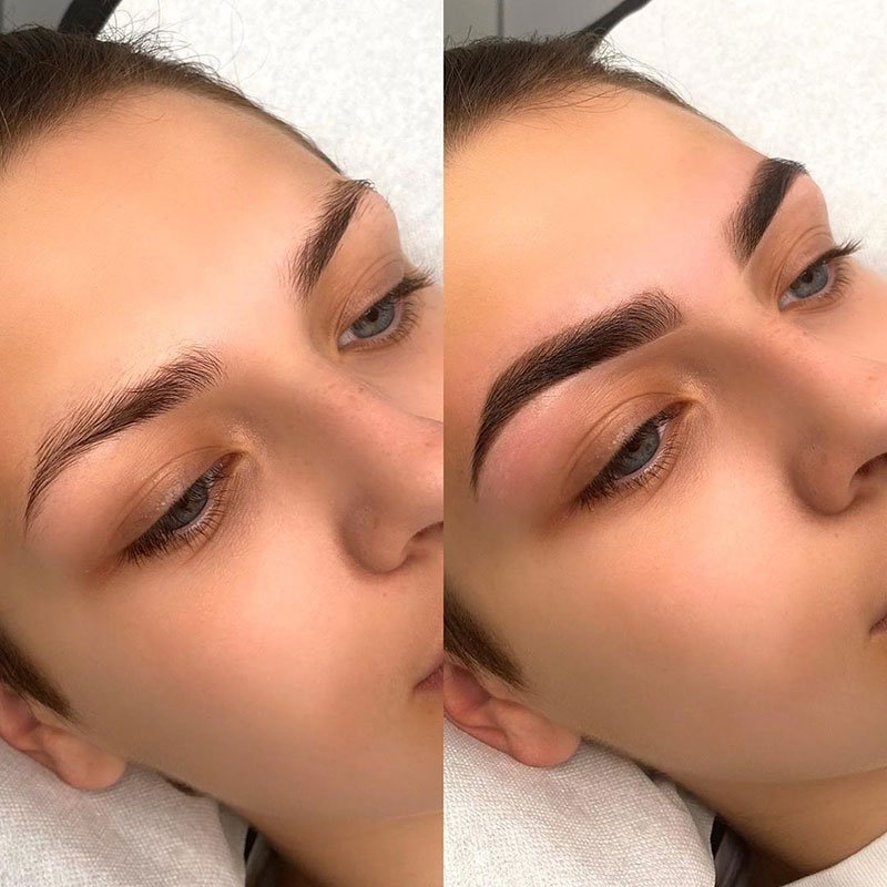 Do I Need A Non-Surgical Eyebrow Lift?
