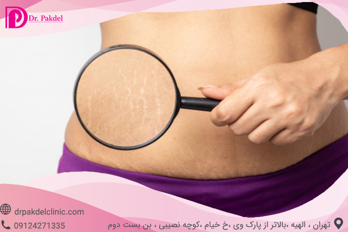 Cause of cellulite and cellulite treatment methods