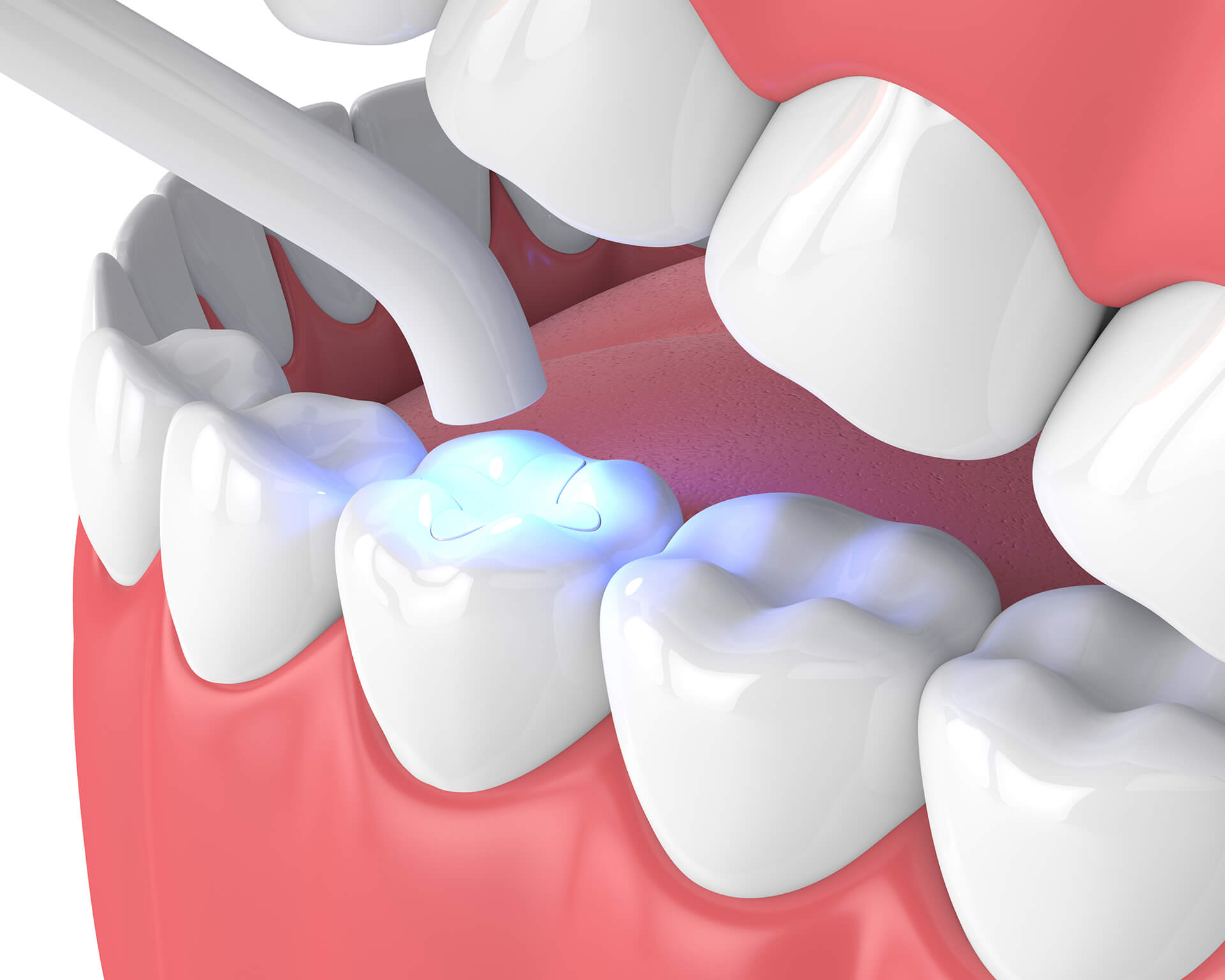 Are Tooth Sealants Safe for Children? Arlington Dental Experts Answer
