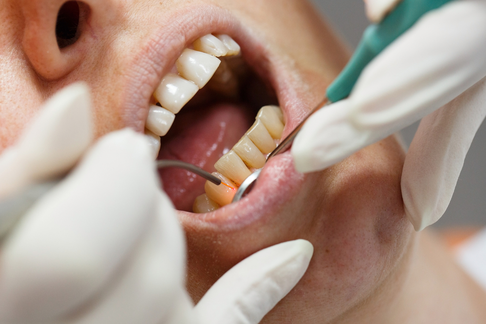 Gum Rejuvenation Made Easy: Explore Laser Gum Surgery in Arlington, VA