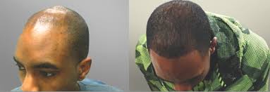 LED VS LLT Hair Treatment