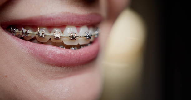 How to Know When It’s Time for Your Child to See an Orthodontist