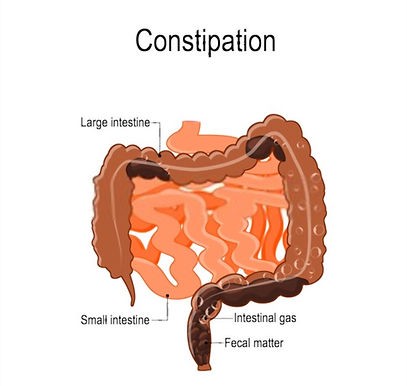 Constipation: What it is, How to Live With It, and How to Get Rid of It