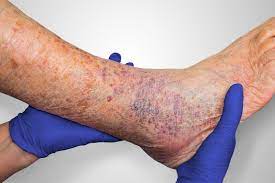 Wound Care specialist For Venous Ulcer Treatment 