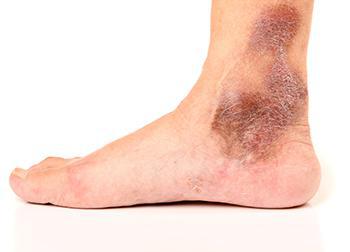 FAQs on Venous Leg Ulcer: Learn from the Expert