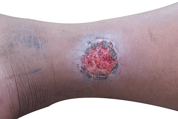 How Venous Leg Ulcer Gets Cured By Venous Ulcer Specialists?
