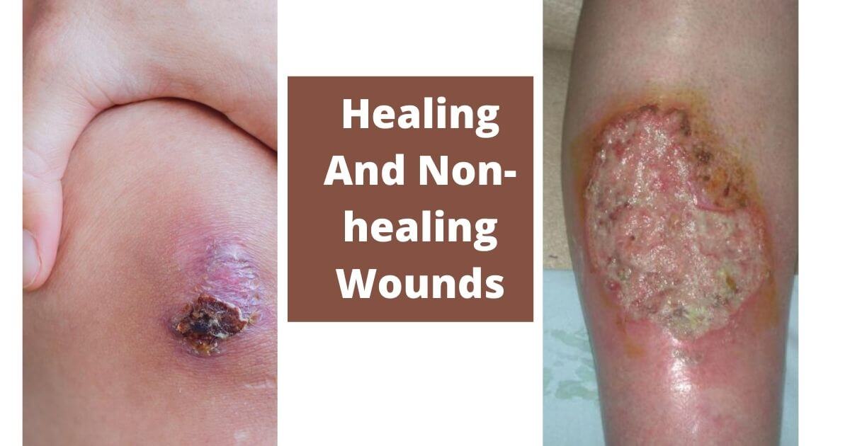  Signs of Healing And Non-healing Wounds