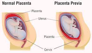 Placenta Previa Treatment In Tirunelveli