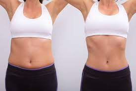 Is Laser Liposuction a Safe Procedure?