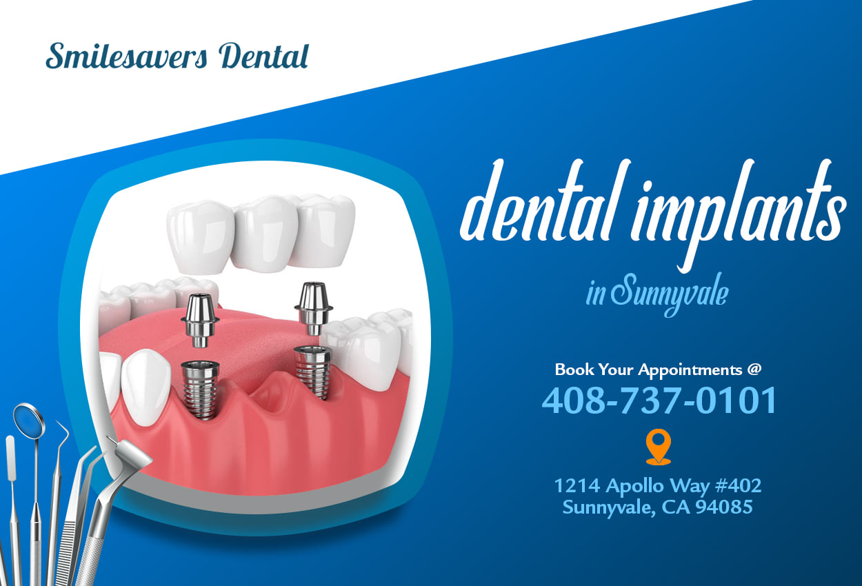 Implants Near Me | Smilesavers Dental