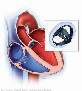 Mechanical  heart valves