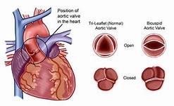 heart valve replacement