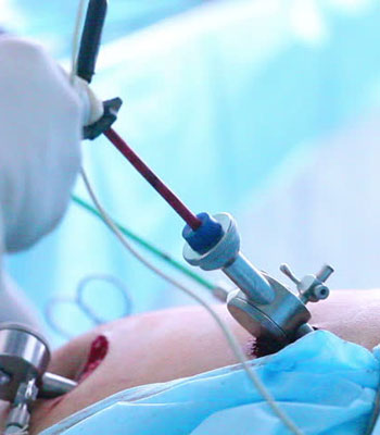 Laparoscopic Surgery in Gynecological Conditions