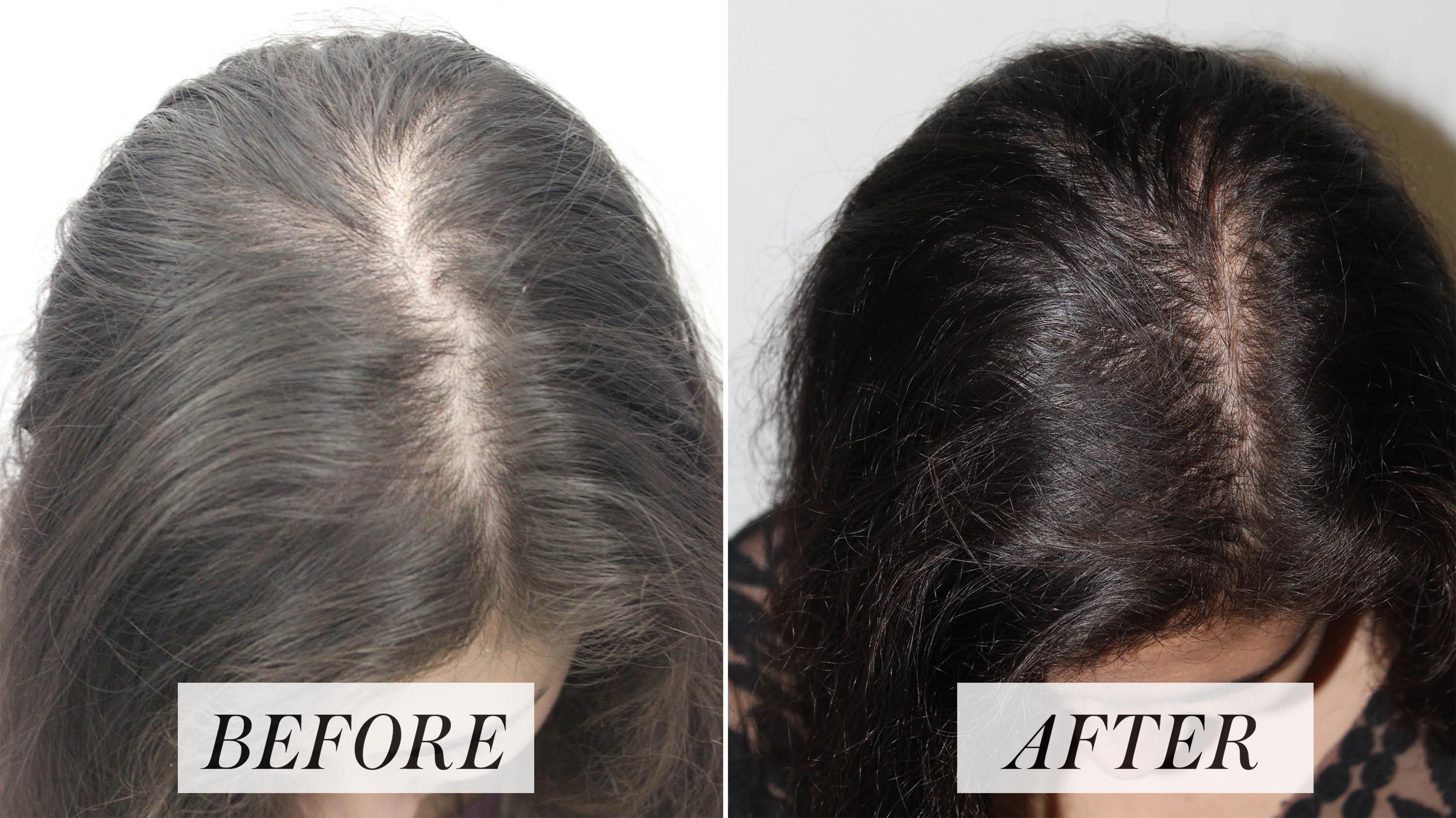 Is Prp Hair Loss Treatment Effective?