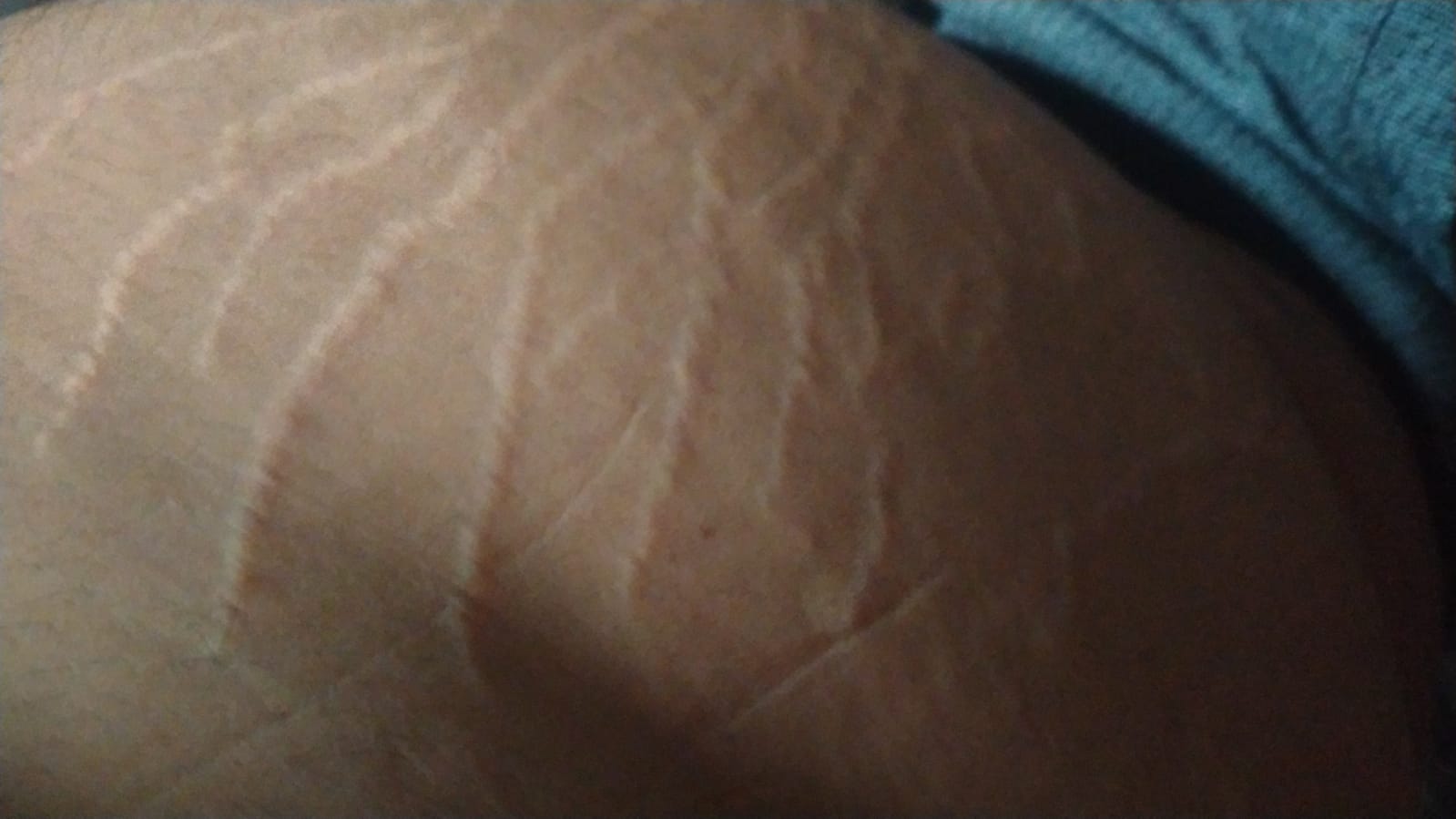Stretch Marks And Its Growth Factor Concentrate