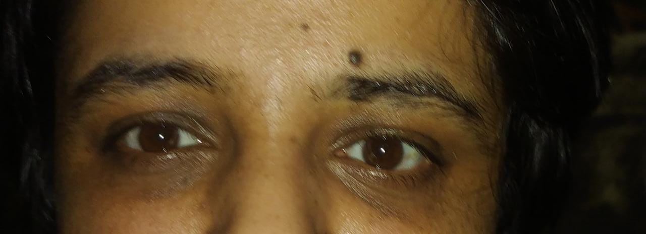 What Are The Reason Of Dark Circles Under The Eyes