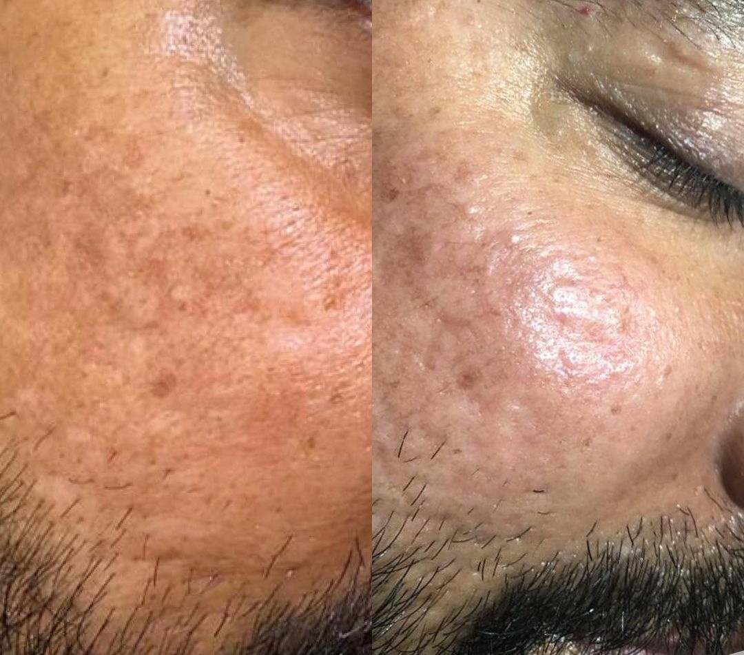 Facial Pigmentation in Men