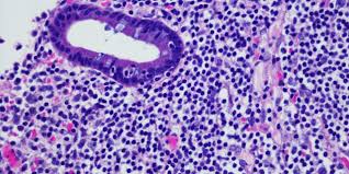 Follicular Lymphoma Treatment Market Size, Status, Growth | Industry Analysis Report 2020-2027