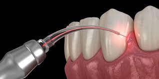 Dental Surgery Lasers Size, Growth & Global Forecast Report to 2027