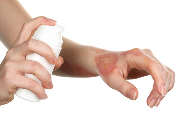 Things You Need To Know About Burn Injuries And Laws