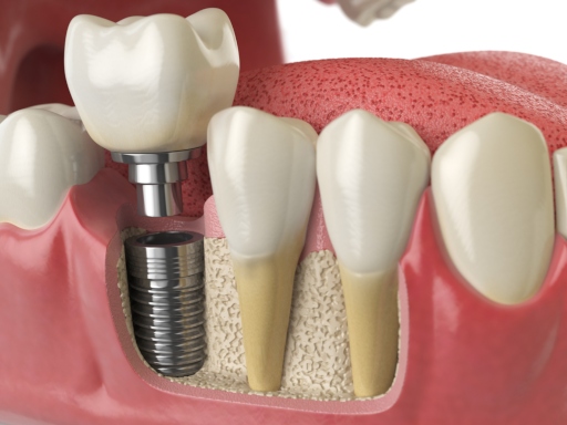 How Long Does the Dental Implant Process Take at Blackburn dentist?