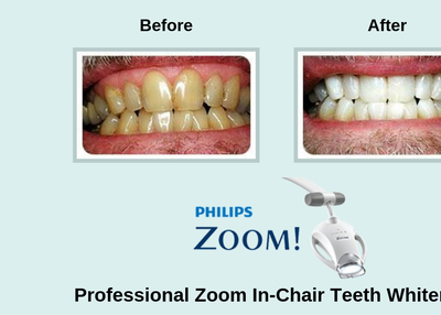 How Does Zoom Teeth Whitening Work?