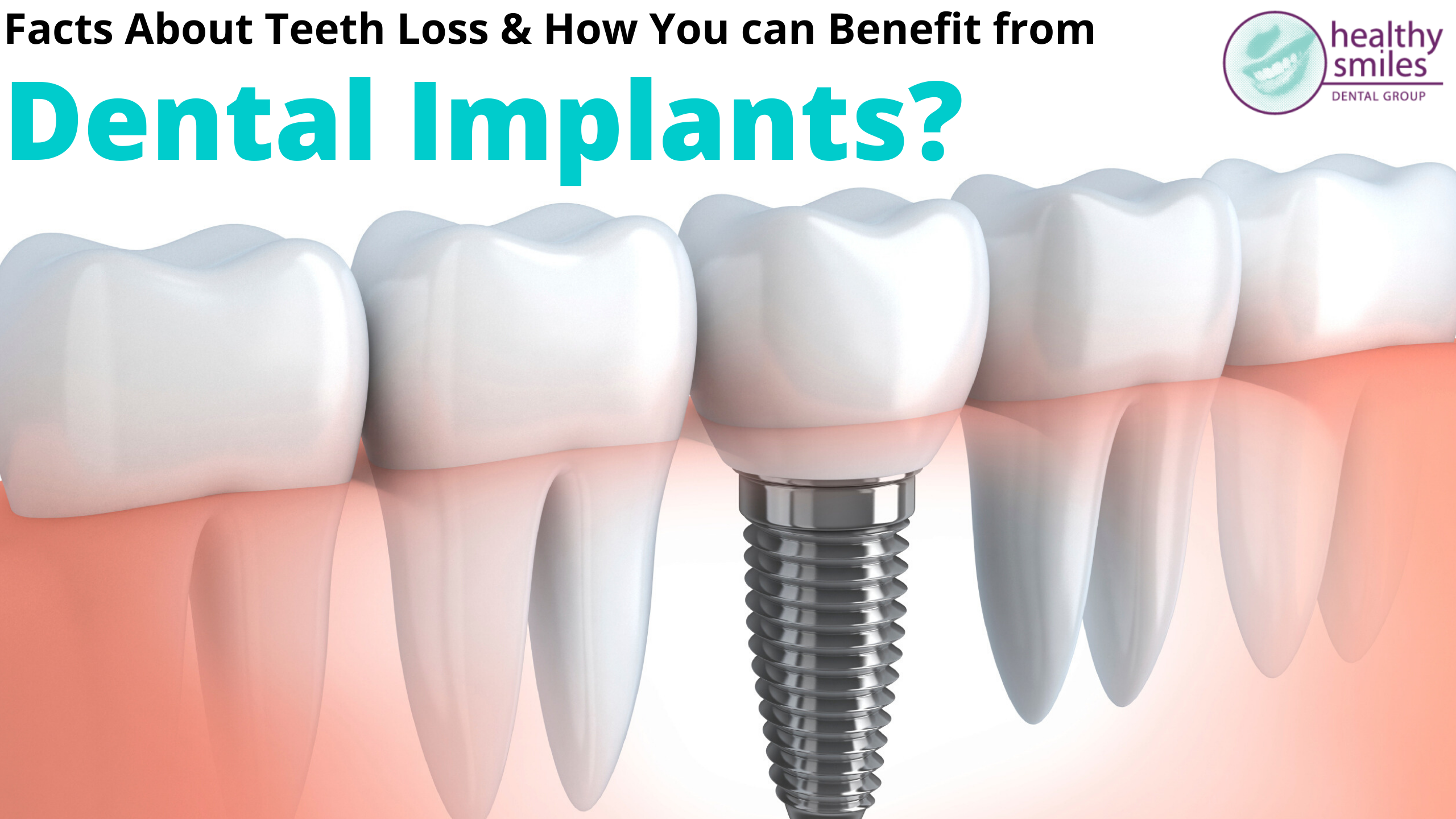 How You Can Benefit from Dental Implants?