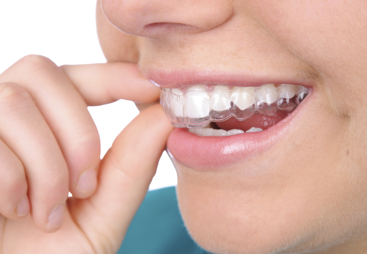 Invisalign - How It Really Works? | Healthy Smiles