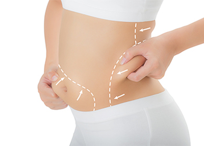 Advanced Liposuction Surgery Delhi for a New You