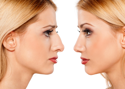 WHAT TO EXPECT BEFORE AND AFTER A NOSE JOB?