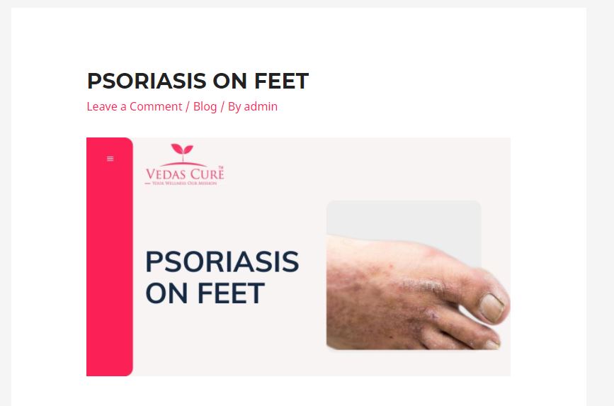 Psoriasis on feet