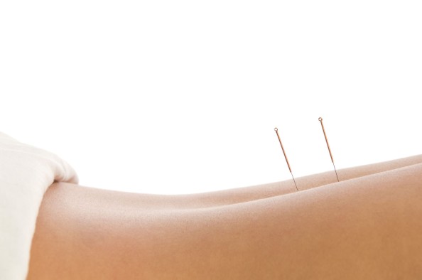 Acupuncture Melbourne