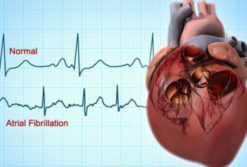 Atrial Fibrillation Treatment Market Price, Size, and Growth Report 2026