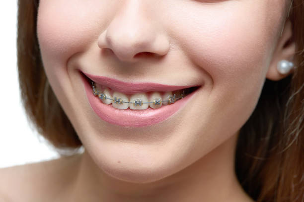 Get A Braces Makeover with Custom Braces in Arcadia CA