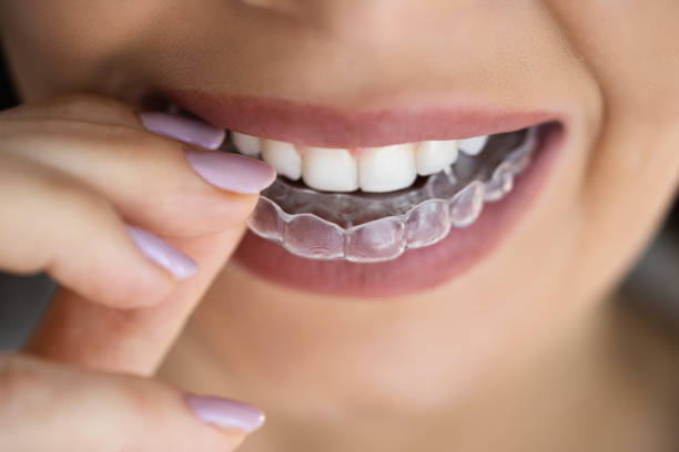Maintaining your straight smile after Invisalign treatment
