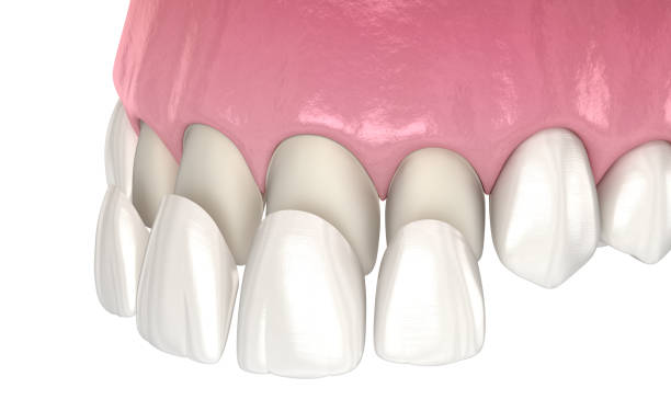 Are dental veneers the right choice if you have sensitive teeth?