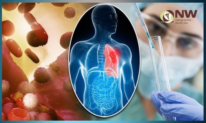 Everything You Need to Know About Immunotherapy for Lung Cancer 