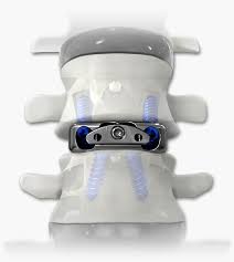 Cervical Interbody Fusion Cages Market Report 2021 | Global Industry Trends, Forecasts and Opportunity Assessment Till 2026