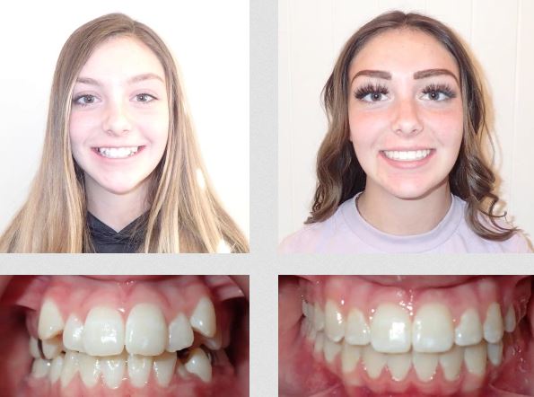 Closing spaces between the upper front teeth