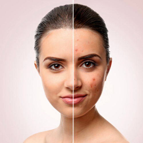 Removing acne scars using Bhubaneswar the treatment for acne can be extremely efficient!