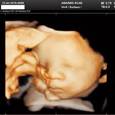 Is Ultrasound Scanning A Must During Pregnancy?