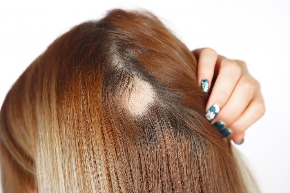 Alopecia and blood circulation: This is how they are related