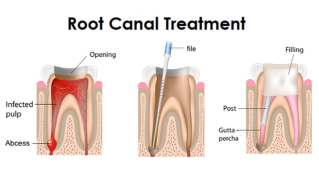 What is a Successful Root Canal?