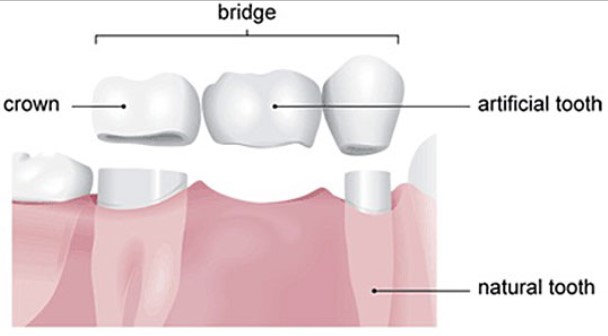 Top 7 Reasons Why You May Need a Dental Crown
